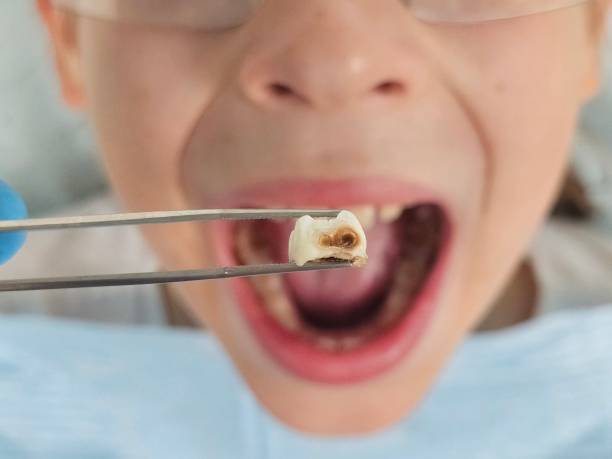 Best Emergency Dentist for Lost Fillings or Crowns in Geneva, IN