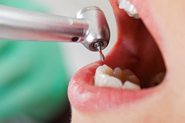 Best Broken or Cracked Tooth Emergency Dentist in Geneva, IN